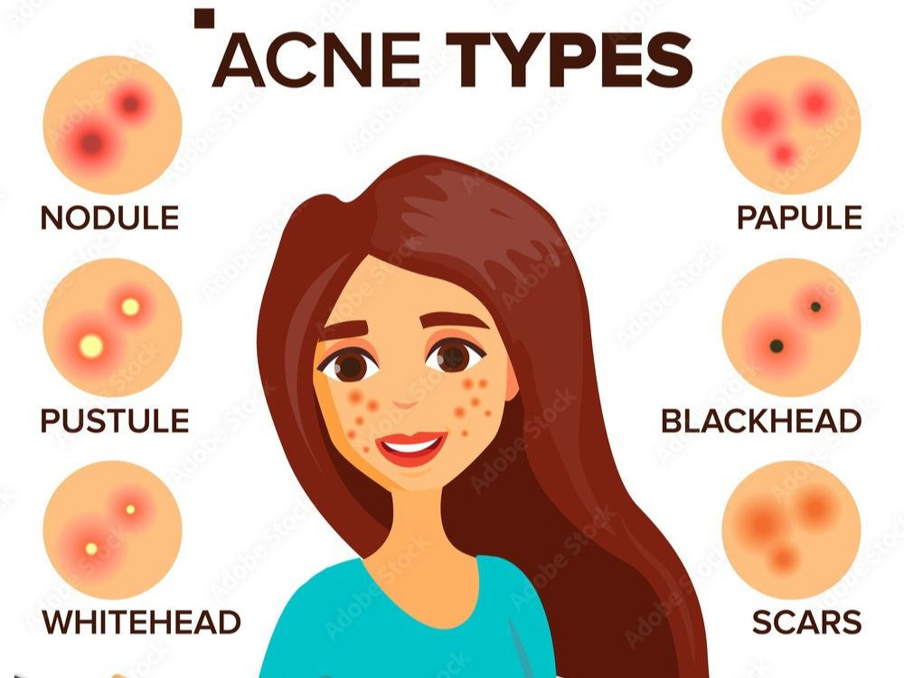 See your types of Acne and Choose Ayurveda for healing the skin issue's 
# 
# 
# 
# 